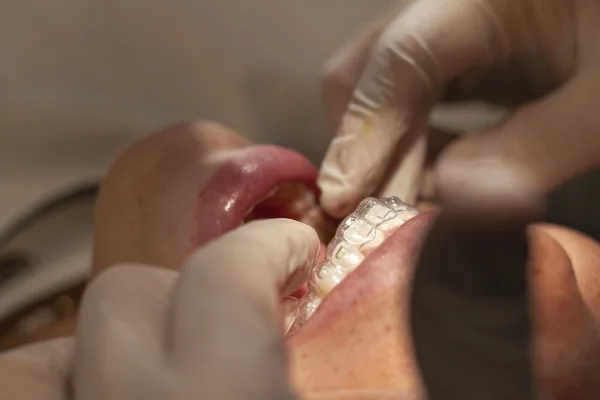 Illustrative service photograph of a dental whitening tray being fitted